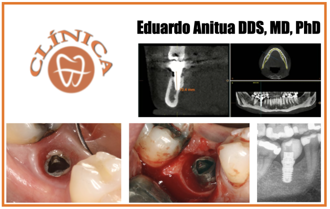 Caso clínico  - Eduardo Anitua DDS, MD, PhD
