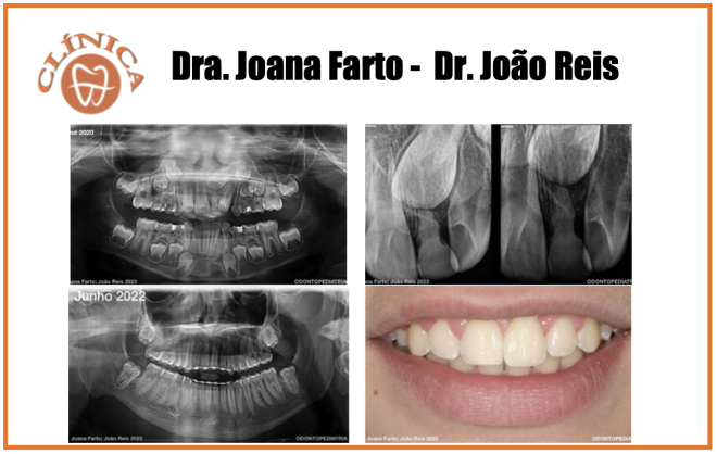 Falha Erupção de Incisivos Centrais - Casos Clínicos 