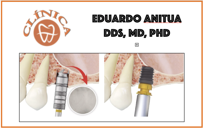 Abordagem do setor posterior maxilar atrófico com baixa densidade 