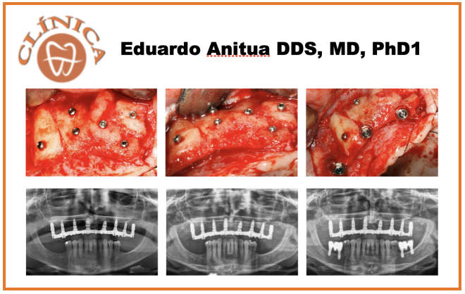Caso clínico -  Dr.Eduardo Anitua