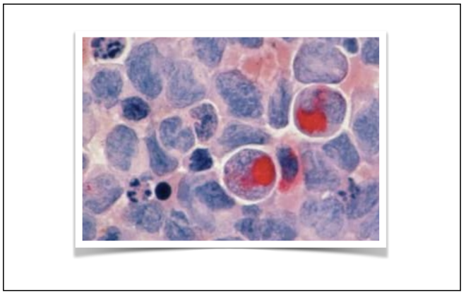 Novo tratamento híbrido obriga as células cancerosas a morrer de fome