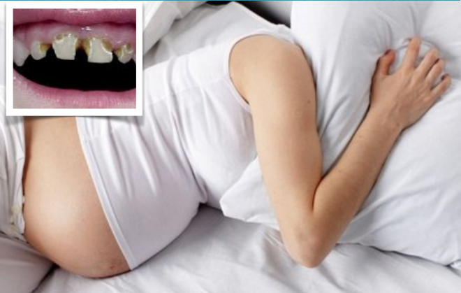 O stress durante a gravidez pode aumentar o risco de cáries dentárias nos filhos