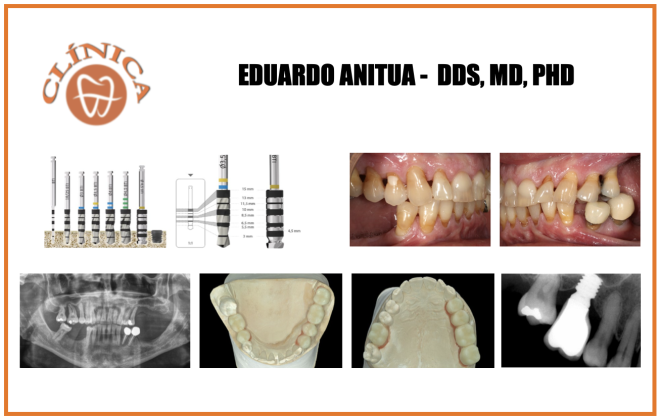 Elevação do seio transcrestal em pacientes com altura óssea residual inferior a 5 mm, baixa densidade óssea e baixo torque de inserção. Série de casos