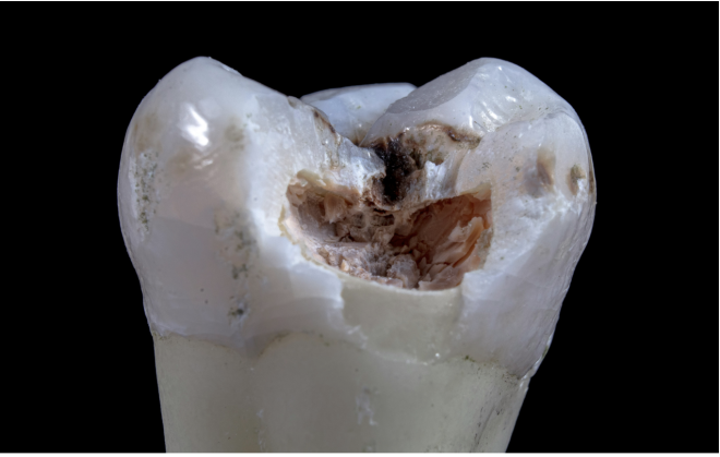 Investigadores da NYU desenvolvem alternativa à base de zinco para o diamino fluoreto de prata