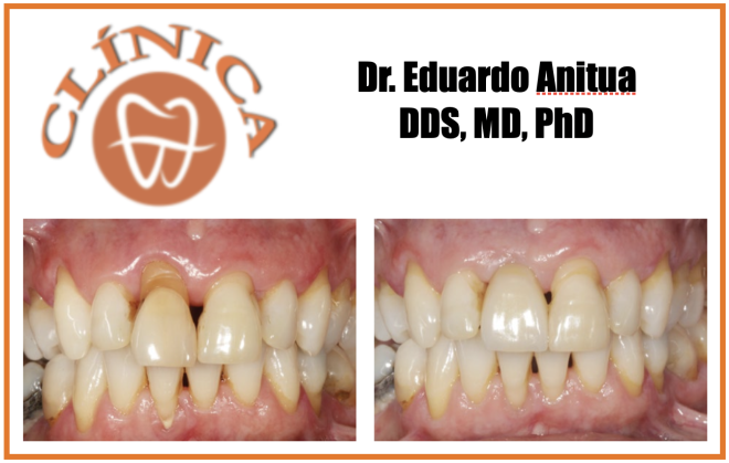 Caso clínico Dr. Eduardo Anitua DDS, MD, PhD