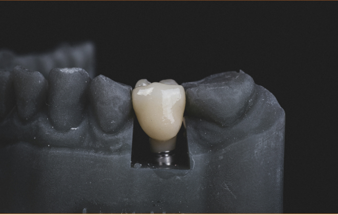 Estudo revela que Implantes dentários continuam funcionais após 40 anos