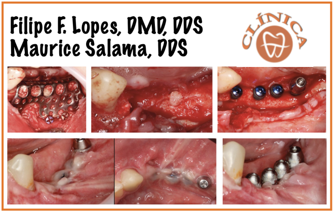 Caso Clínico: Dr. Filipe F. Lopes, DMD, DDS. e Dr.  Maurice Salama, DDS