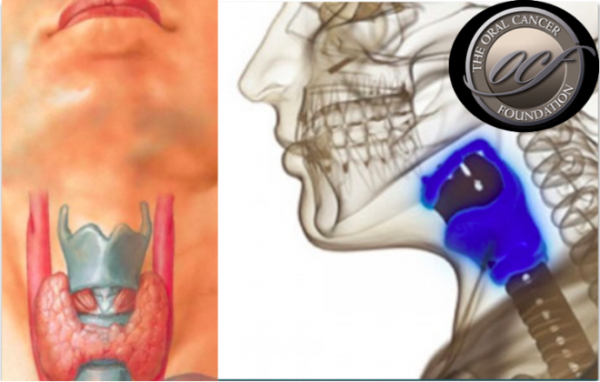 Implante de laringe artificial ajuda paciente com cancro na garganta a respirar normalmente e falar