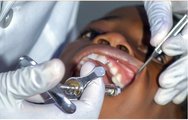 Programa dentário escolar em  N.York previne 80% das cáries com tratamento único e não invasivo