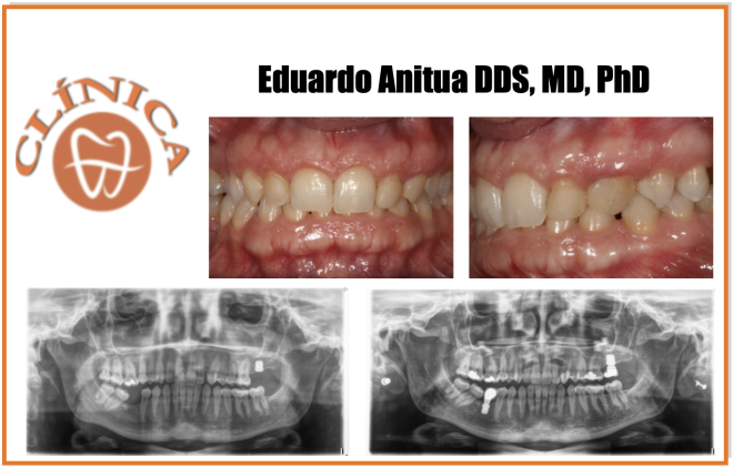 Implante curto unitário (5,5 e 6,5 mm) no segundo molar superior com elevação do seio transcrestal e enxerto autólogo obtido com o preparo alveolar. série de casos com análise retrospectiva.