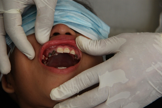 Ligação entre depressão e menor diversidade do microbioma oral