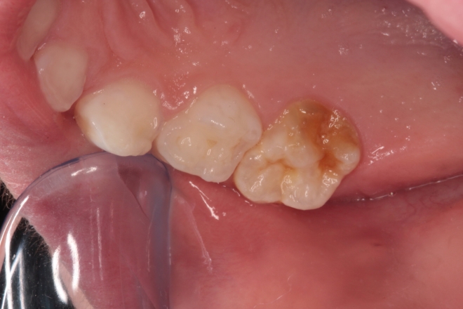 Explicado o mistério dos Dentes de Giz das crianças