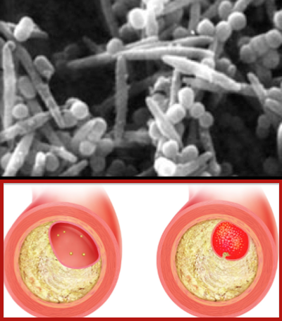 ESTUDO EVIDENCIA O PAPEL DA PORPHYROMONAS GINGIVALIS NO DESENVOLVIMENTO E PROGRESSÃO DA ATEROSCLEROSE