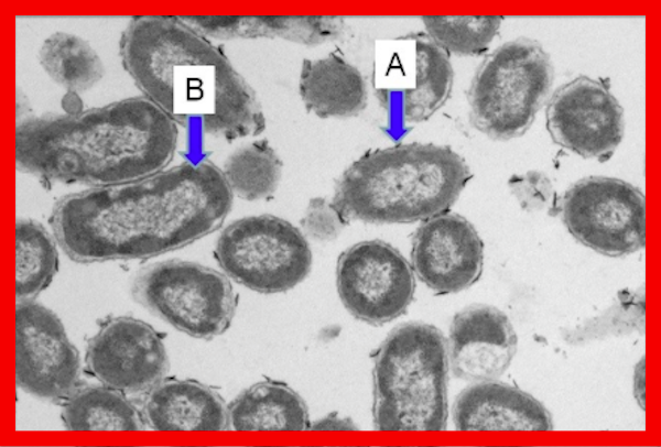 NBW3 (Ozônio - Nano-Bolha de Água) - COM  POTENCIAL PARA TRATAMENTO DAS INFEÇÕES GRAVES DAS GENGIVAS