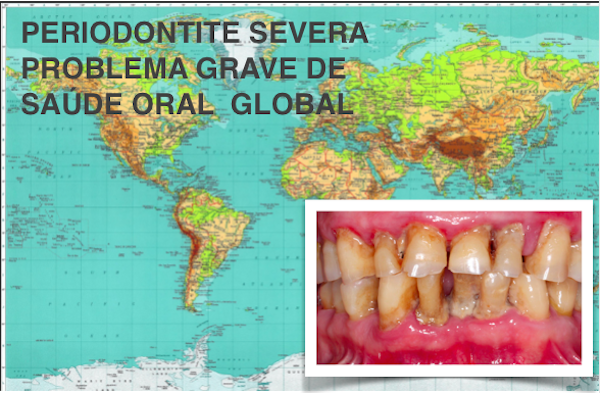 ESTUDO INTERNACIONAL SOBRE PERIODONTITE SEVERA REVELA SITUAÇÃO PREOCUPANTE