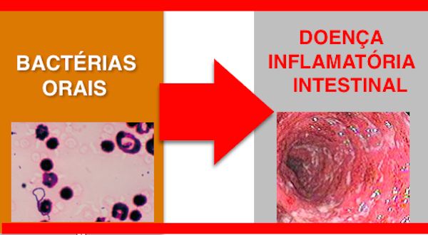 ESTUDO REVELA QUE AS BACTÉRIAS ORAIS AGRAVAM  AS DOENÇAS INFLAMATÓRIAS INTESTINAIS (DII)