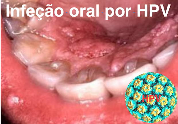  INFEÇÃO ORAL POR HPV É MAIS PERSISTENTE EM HOMENS MAIS VELHOS