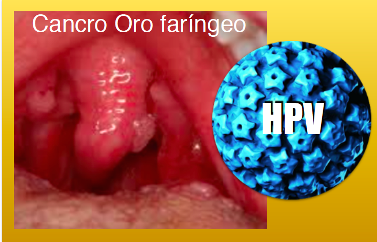 POSSIBILIDADE DE CURA DE CANCRO ORO-FARÍGEO EM PACIENTES COM HPV — NOVAS INVESTIGAÇÕES