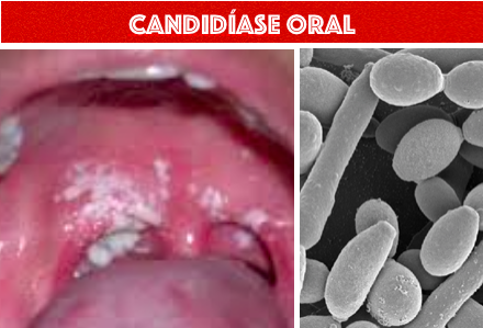 ESTUDO MOSTRA COMO AS CÉLULAS T CAUSAM INFLAMAÇÃO DURANTE UMA INFEÇÃO POR CANDIDÍASE ORAL