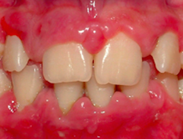 PODE EXISTIR UMA LIGAÇÃO ENTRE SAÚDE ORAL E ARTRITE REUMATÓIDE