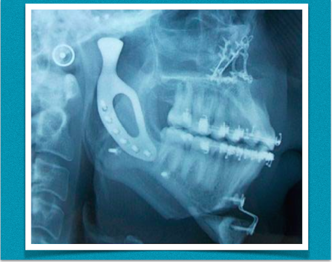 TRANSPLANTE DE MANDÍBULA IMPRESSO EM 3D