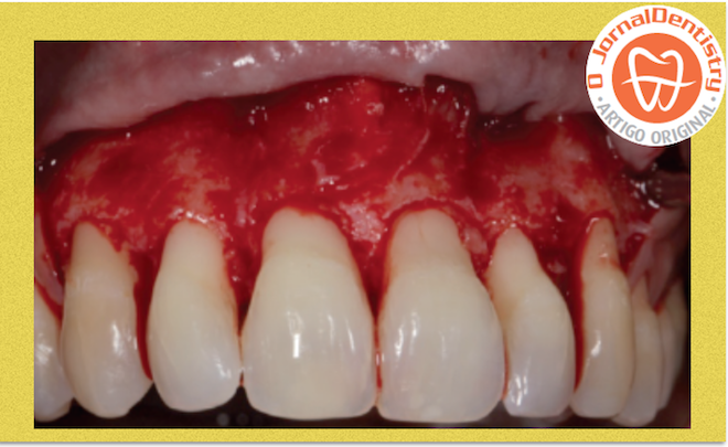 REMODELAÇÃO DO BIÓTIPO GENGIVAL FINO EM ZONAS ESTÉTICAS APÓS TRATAMENTO PERIODONTAL