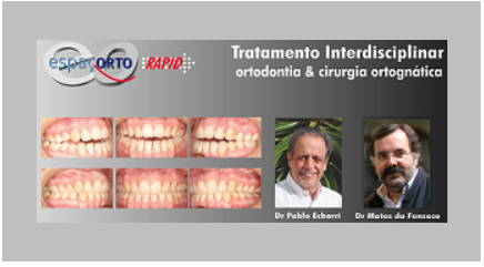 TRATAMENTO INTERDISCIPLINAR ORTODONTIA & CIRURGIA ORTOGNÁTICA